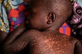 Measles Outbreak in Mangochi