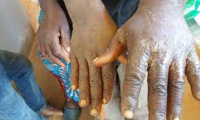 Machinga  records over 200 Scabies cases