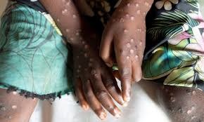 Africa CDC declares Mpox outbreak public health emergency