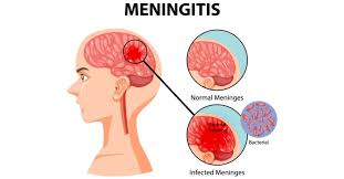 Meningitis